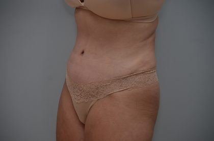 Abdominoplasty Before & After Patient #3489