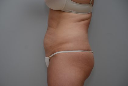 Abdominoplasty Before & After Patient #3489