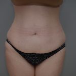 Liposuction with Bodytite Before & After Patient #3535