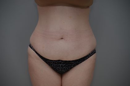 Liposuction with Bodytite Before & After Patient #3535