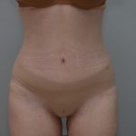 Liposuction with Bodytite Before & After Patient #3535