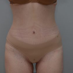 Liposuction with Bodytite Before & After Patient #3535