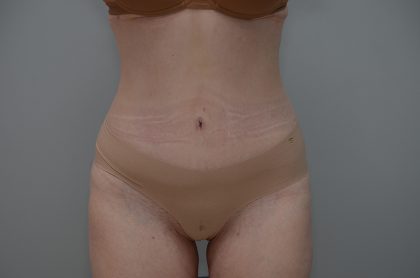 Liposuction with Bodytite Before & After Patient #3535