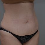 Liposuction with Bodytite Before & After Patient #3535