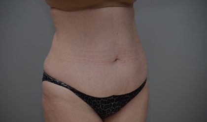 Liposuction with Bodytite Before & After Patient #3535