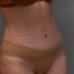 Liposuction with Bodytite Before & After Patient #3535