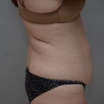 Liposuction with Bodytite Before & After Patient #3535