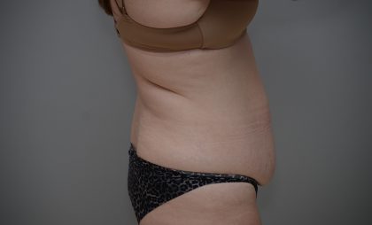 Liposuction with Bodytite Before & After Patient #3535