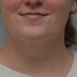 Neck Liposuction Before & After Patient #3546