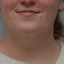 Neck Liposuction Before & After Patient #3546