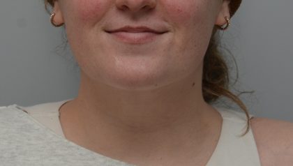 Neck Liposuction Before & After Patient #3546