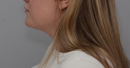 Neck Liposuction Before & After Patient #3546