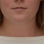 Neck Liposuction Before & After Patient #3546
