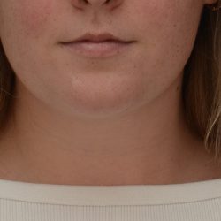 Neck Liposuction Before & After Patient #3546