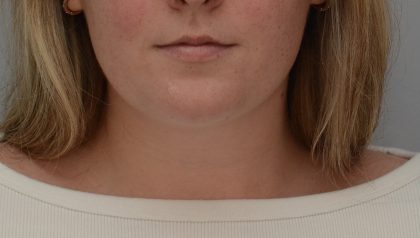 Neck Liposuction Before & After Patient #3546