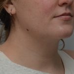 Neck Liposuction Before & After Patient #3546