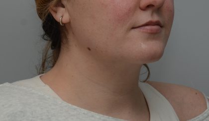 Neck Liposuction Before & After Patient #3546