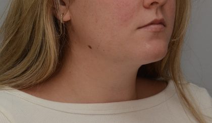 Neck Liposuction Before & After Patient #3546