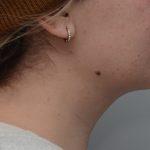 Neck Liposuction Before & After Patient #3546