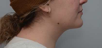 Neck Liposuction Before & After Patient #3546