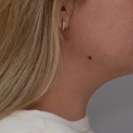 Neck Liposuction Before & After Patient #3546