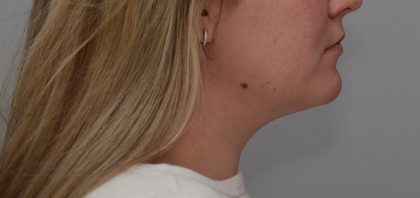 Neck Liposuction Before & After Patient #3546
