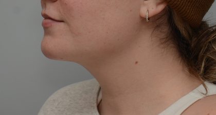 Neck Liposuction Before & After Patient #3546