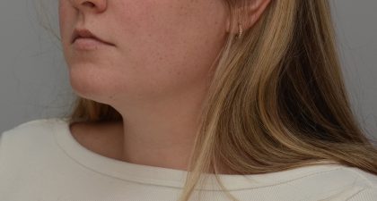 Neck Liposuction Before & After Patient #3546
