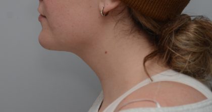 Neck Liposuction Before & After Patient #3546