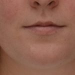 Lip Filler Before & After Patient #3558