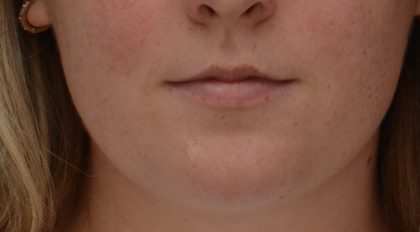 Lip Filler Before & After Patient #3558