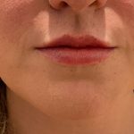 Lip Filler Before & After Patient #3558