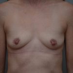 Breast Augmentation Before & After Patient #3561
