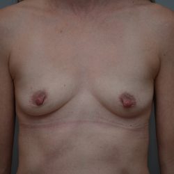 Breast Augmentation Before & After Patient #3561