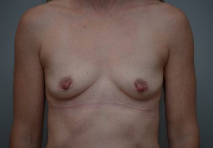Breast Augmentation Before & After Patient #3561