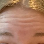 Botox Before & After Patient #3572
