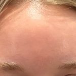 Botox Before & After Patient #3572