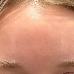 Botox Before & After Patient #3572