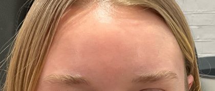 Botox Before & After Patient #3572