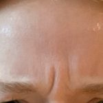 Botox Before & After Patient #3572