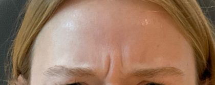 Botox Before & After Patient #3572