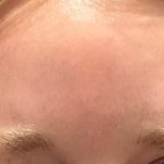 Botox Before & After Patient #3572