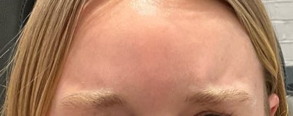 Botox Before & After Patient #3572