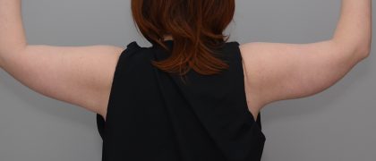 Arm Lift Before & After Patient #3580
