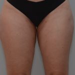 Liposuction with Bodytite Before & After Patient #3585