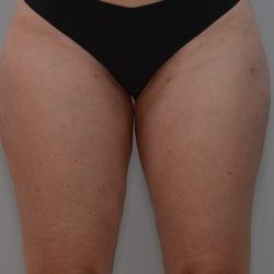 Liposuction with Bodytite Before & After Patient #3585