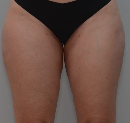 Liposuction with Bodytite Before & After Patient #3585