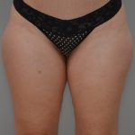 Liposuction with Bodytite Before & After Patient #3585