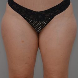 Liposuction with Bodytite Before & After Patient #3585