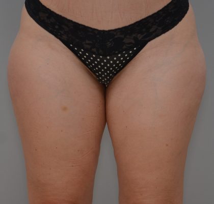 Liposuction with Bodytite Before & After Patient #3585